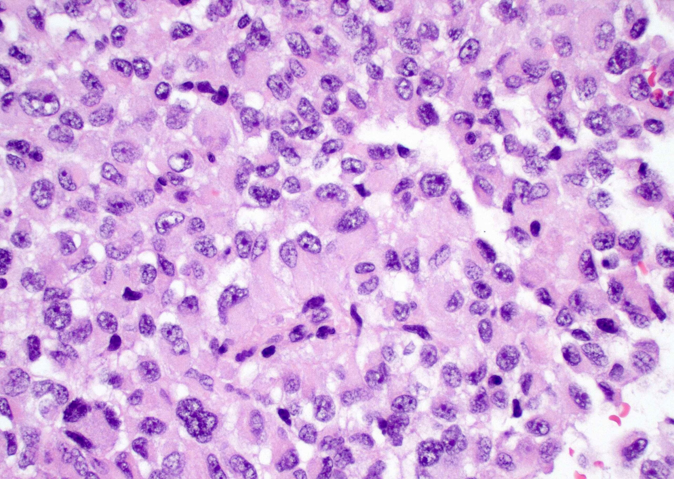 Diakonos Completes Phase 1 GBM Recruitment